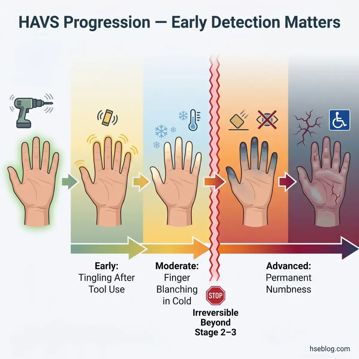 Infographic showing HAVS progression stages from early tingling after tool use through moderate finger blanching in cold to advanced permanent numbness, with a stop point indicating irreversible damage beyond stage 2-3.
